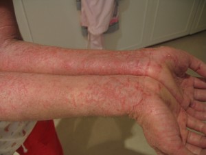 benh cham eczema