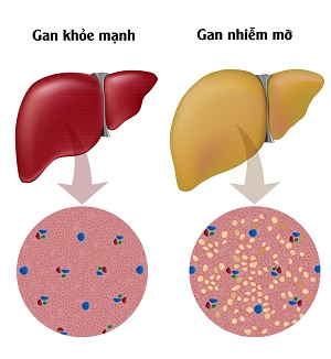 nhung hieu lam ve gan nhiem mo