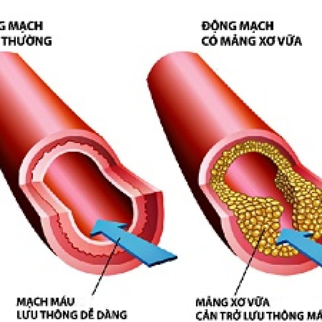 vi sao nguoi tieu duong de bi tang trigyceride mau