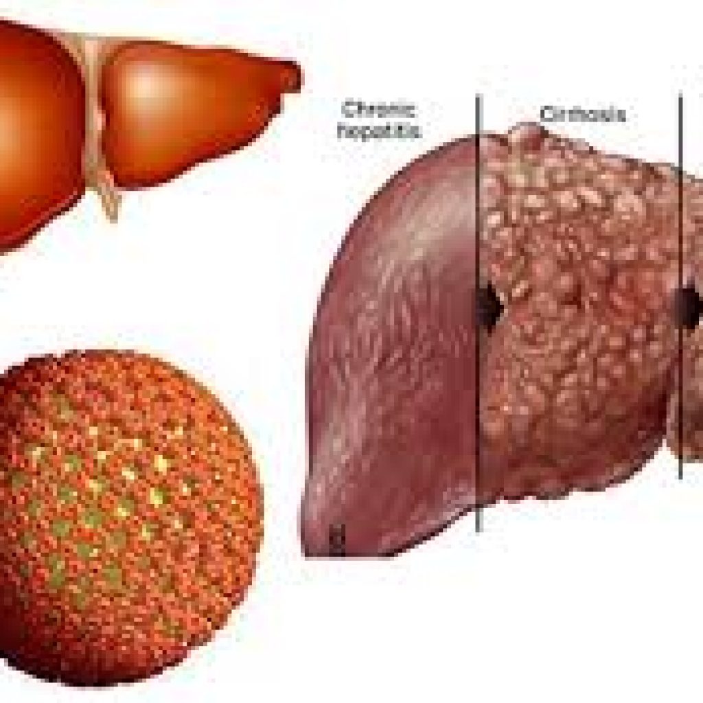 nhiem-virus-viem-gan-b-co-bi-xo-gan-khong