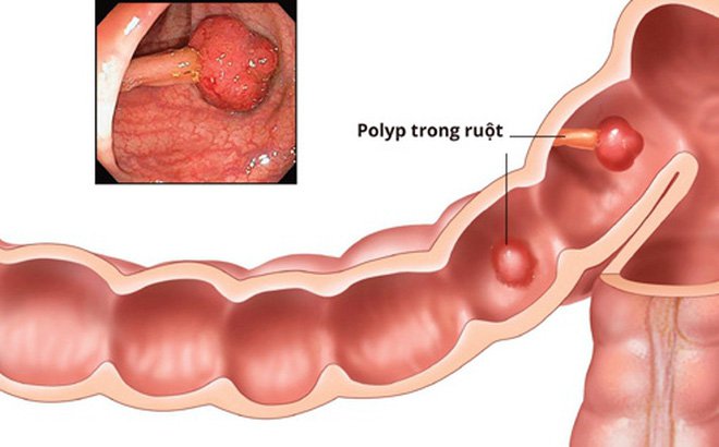 polyp ung thư đại tràng