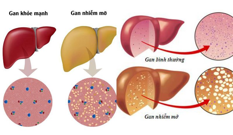 chăm sóc gan nhiễm mỡ