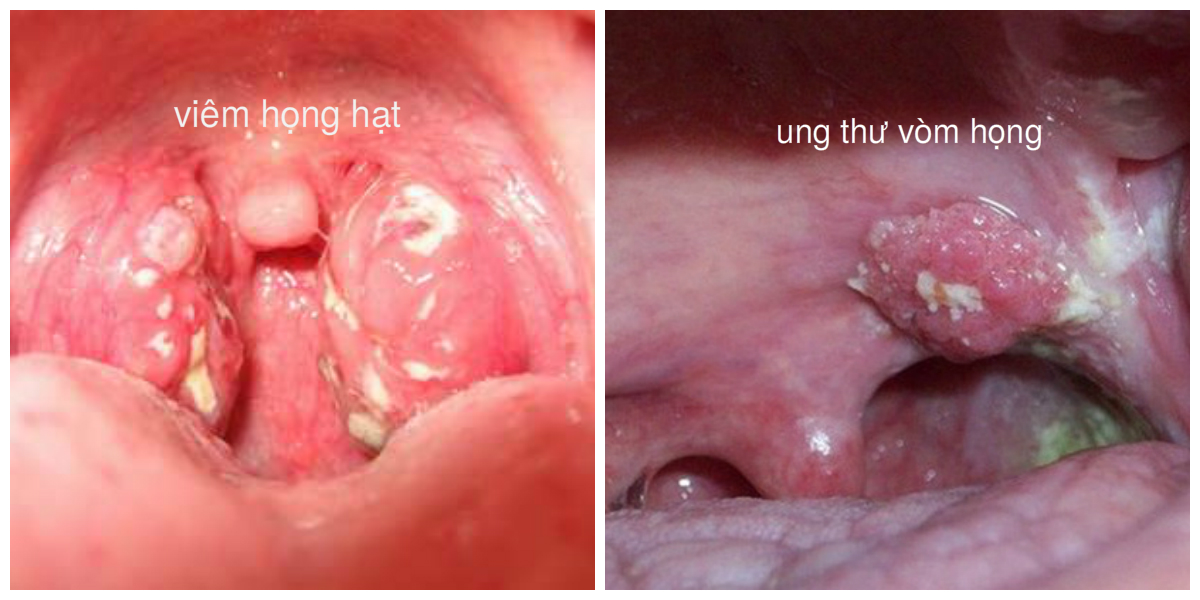 Phân biệt ung thư vòm họng và viêm họng thông thường