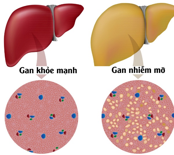 trà xanh ngừa gan nhiễm mỡ