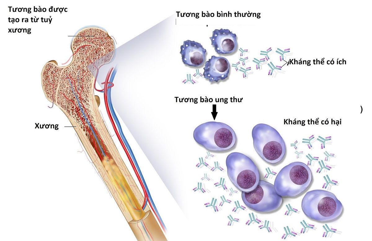 ung thư tủy giai đoạn cuối