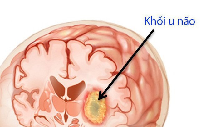 triệu chứng u não