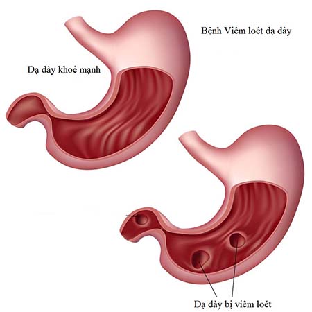 3 loại viêm là "đồng bọn" của ung thư