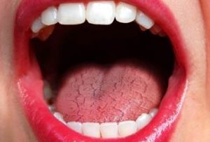 Những triệu chứng bệnh tiểu đường xuất hiện ở miệng