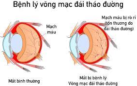 Biến chứng tiểu đường gây mù mắt 