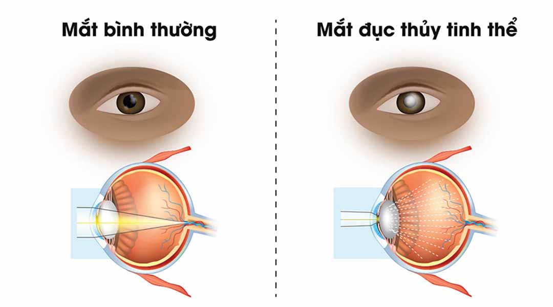 Biến chứng tiểu đường gây mù mắt 